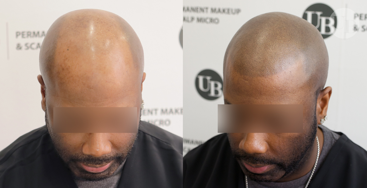 SCALP MICROPIGMENTATION – Unyozi Beauty – Permanent Makeup ...