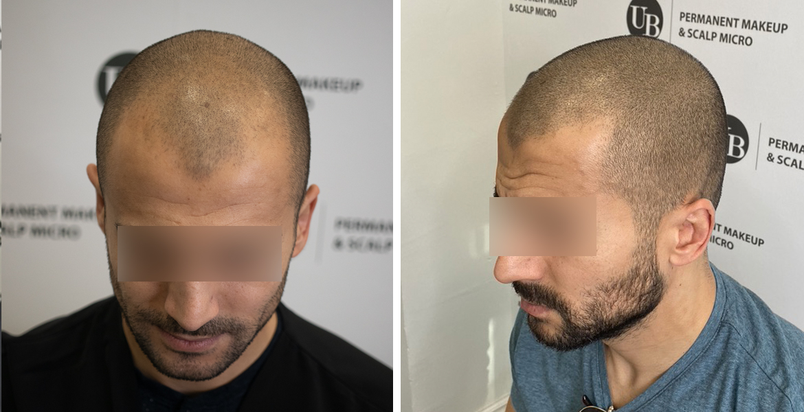 SMP-hair-loss-solutions-toronto
