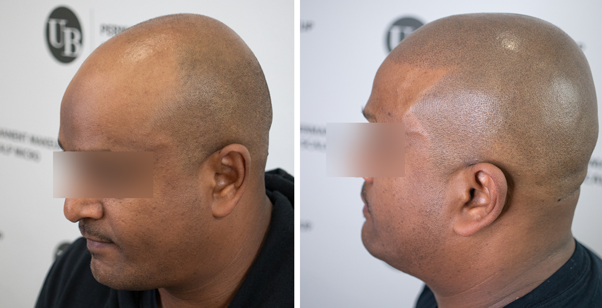 hairline-restoration-scalp-micropigmentation-unyozibeauty