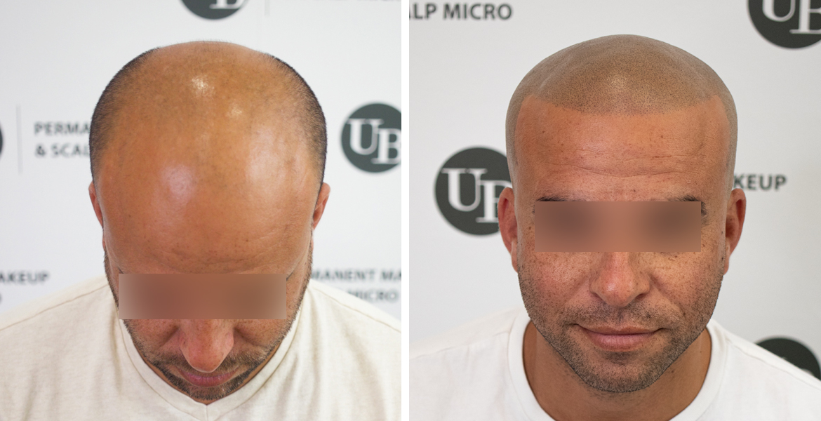 hairline-tattoo-scalp-micropigmentation-toroonto