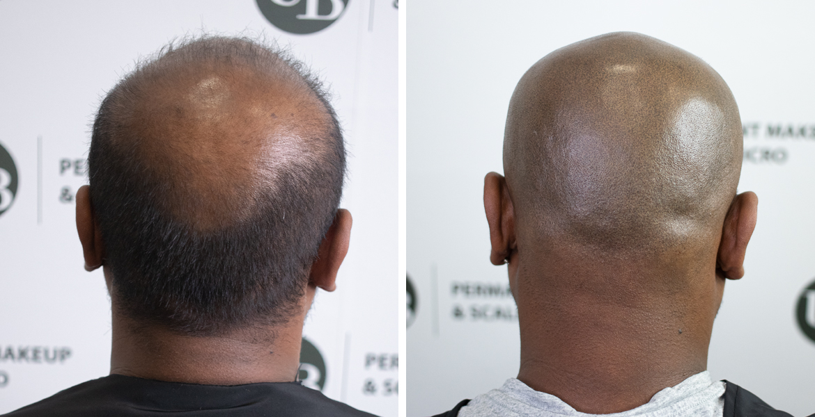 new-hairline-with-hair-pigmentation-unyozibeauty