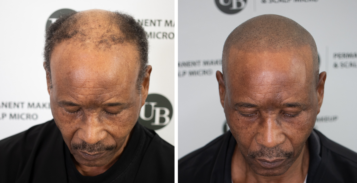 scalp-micropigmentation-hairline-rejuvenation-toronto