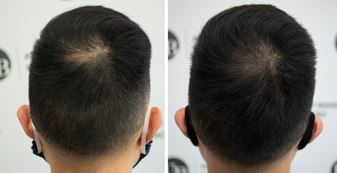 thinning-hair-solutions-scalp-micropigmentation-toronto