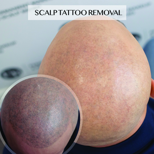 scalp-tattoo-removal-toronto-unyozibeauty