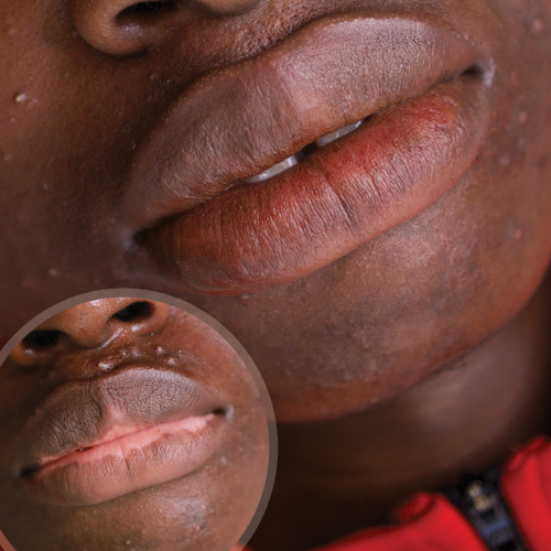 Vitiligo Medical Pigmentation - Unyozi Beauty - Permanent Makeup & Scalp  Micropigmentation