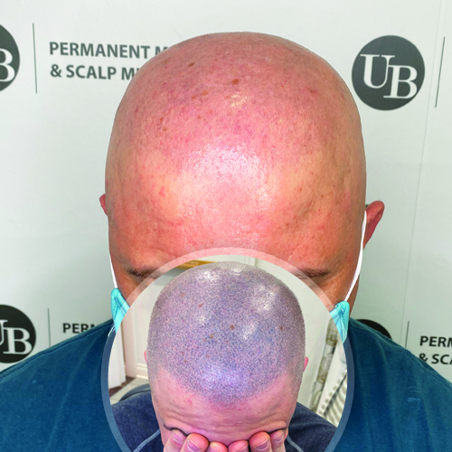 laser-scalp-pigmentation-removal-unyozibeuaty
