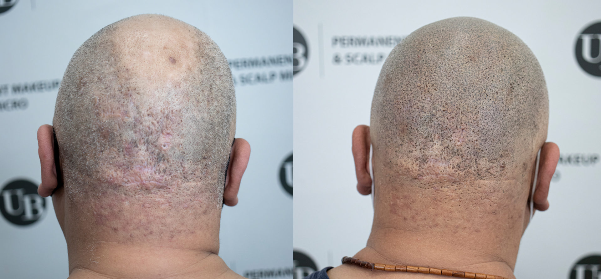 Amazing-Transformation-Scalp-Micropigmentation-Hairline-Tattoo-unyozibeauty