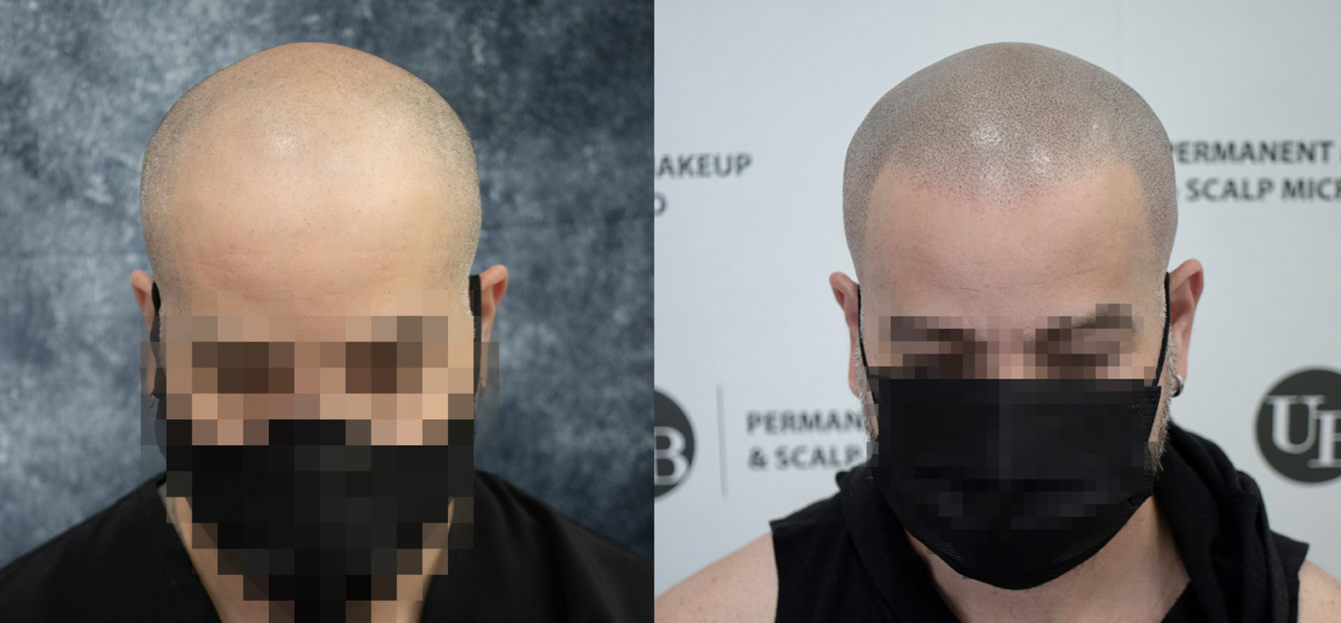Broken-Faded-Hairline-Scalp-Micropigmentation-Toronto
