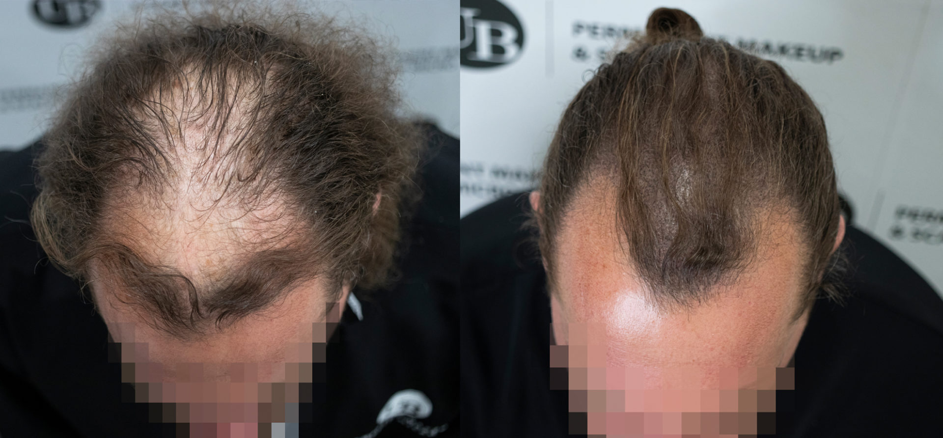 Camouflaging-Hair-loss-Scalp-Micropigmentation-Toronto