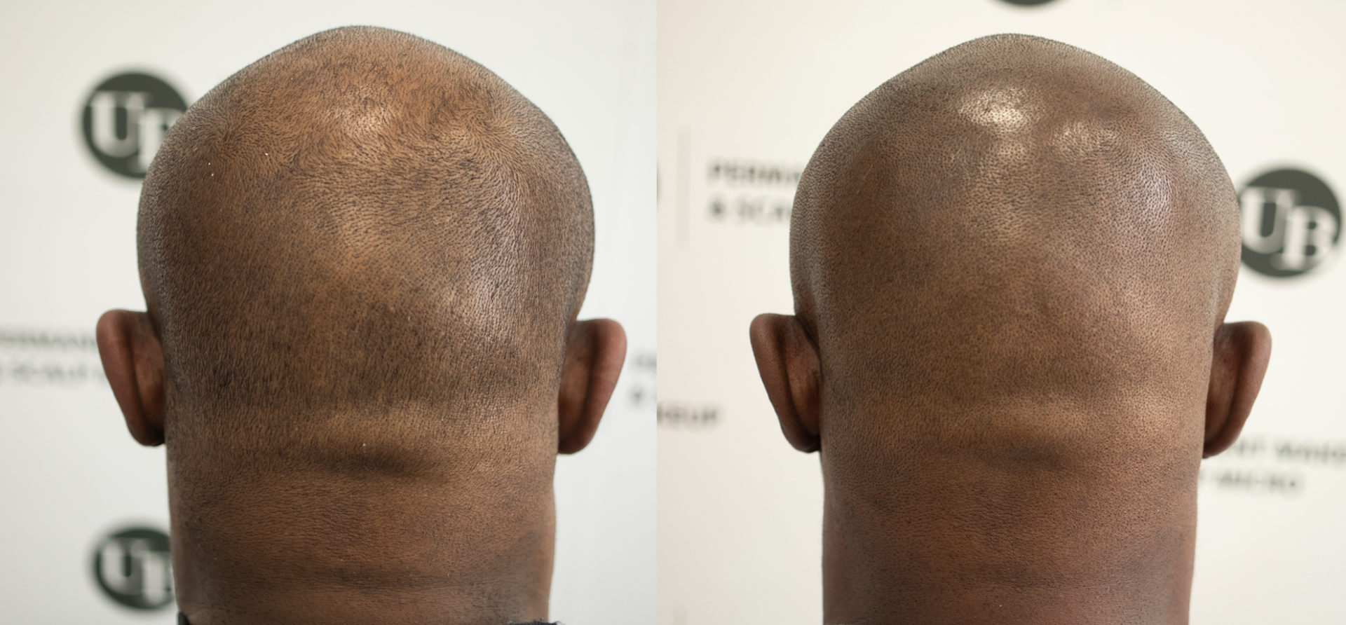 Hair-Density-Treatment-dark-skin-toronto