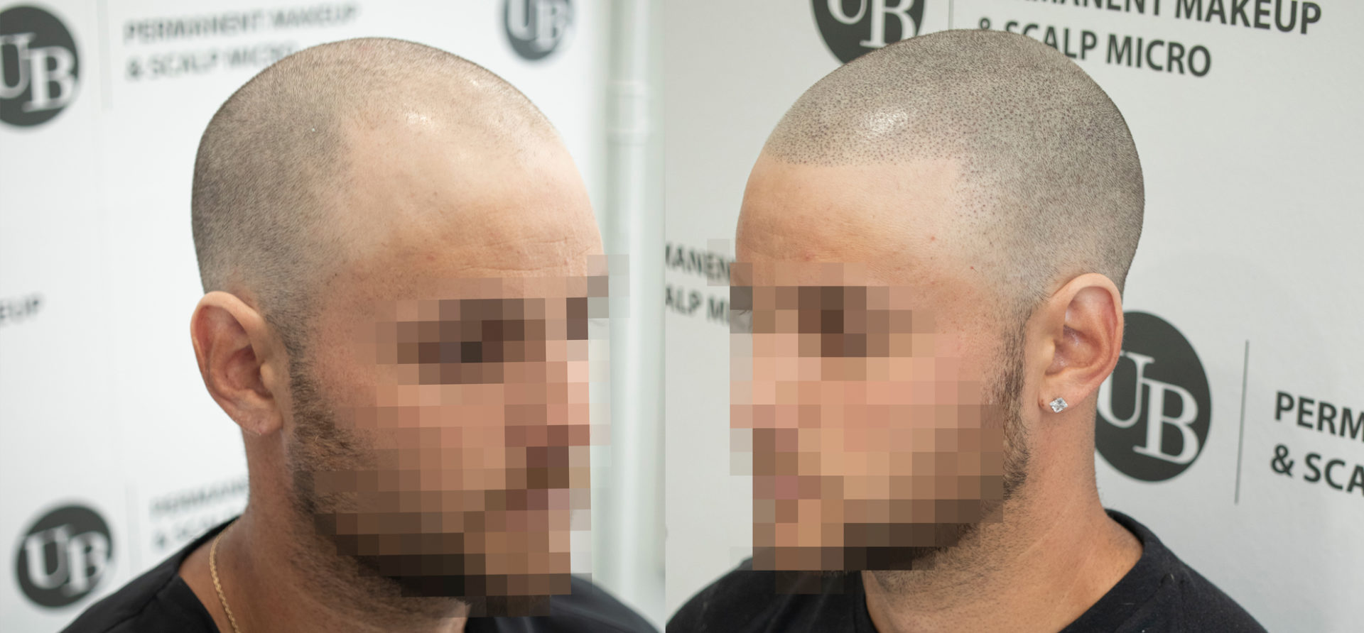 Hair-Loss-Help-Scalp-pigmentation-Toronto-Unyozibeauty
