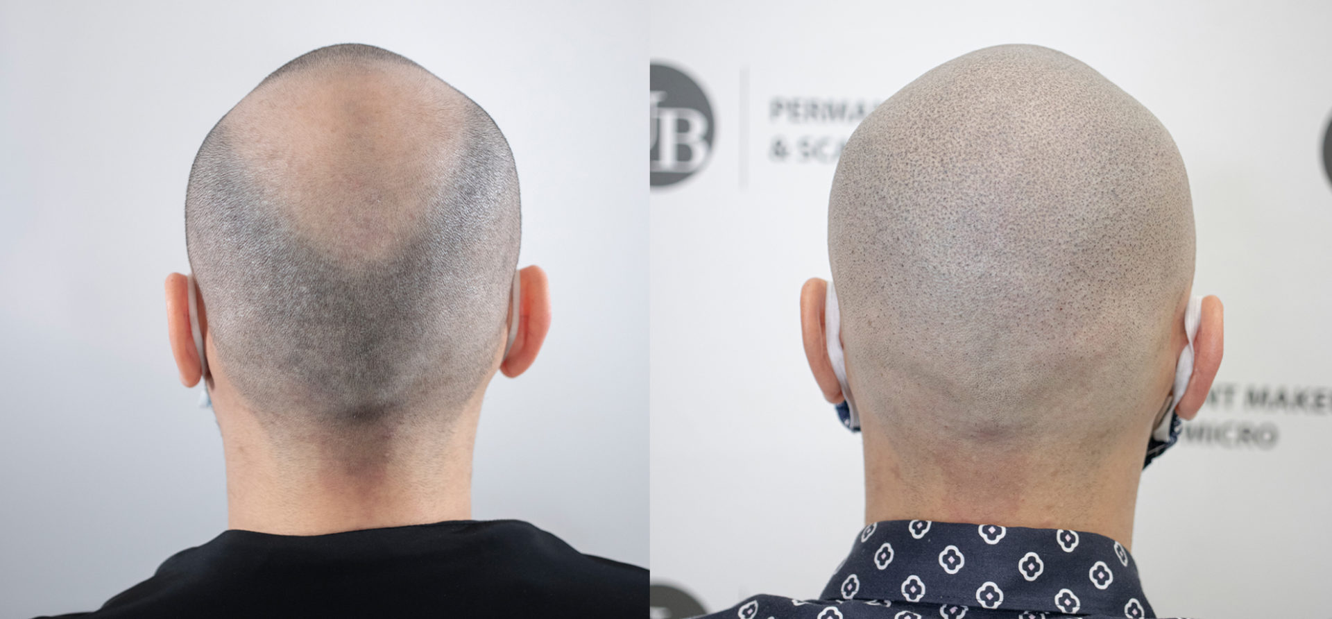 Hair-loss-gone-with-SMP-Hair-tattoo-unyozibeauty