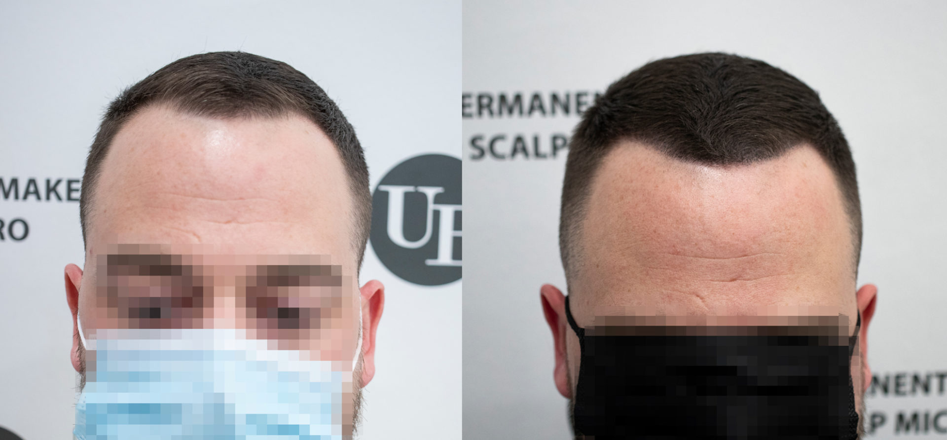 Hairline-Density-with-Scalp-Micropigmentation