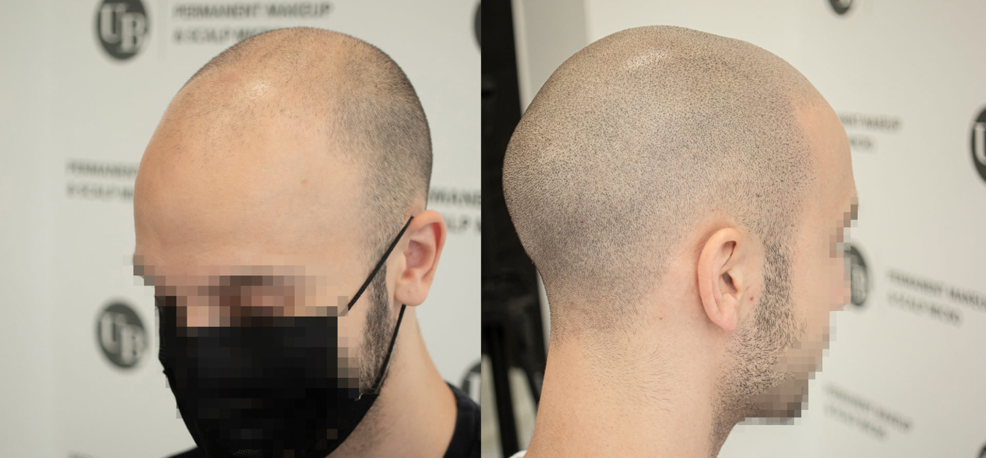 Hairline-Restoration-Scalp-Micrpigmentation-unyozibeauty