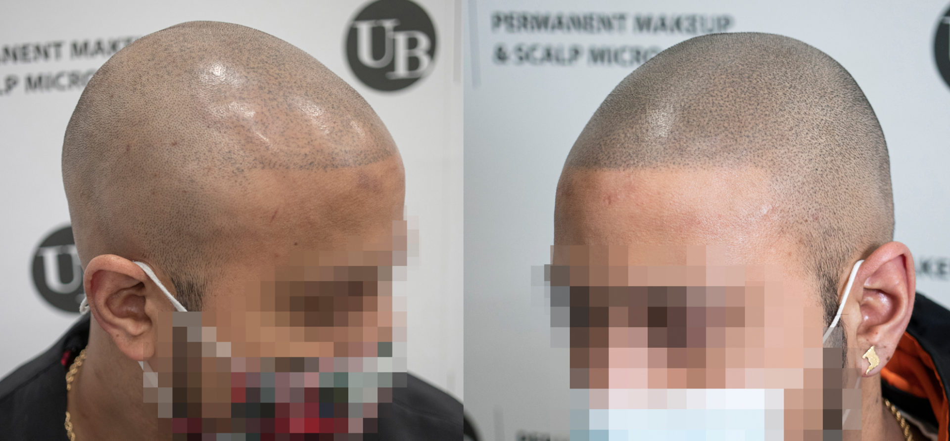 Hairline-repaired-after-botched-SMP