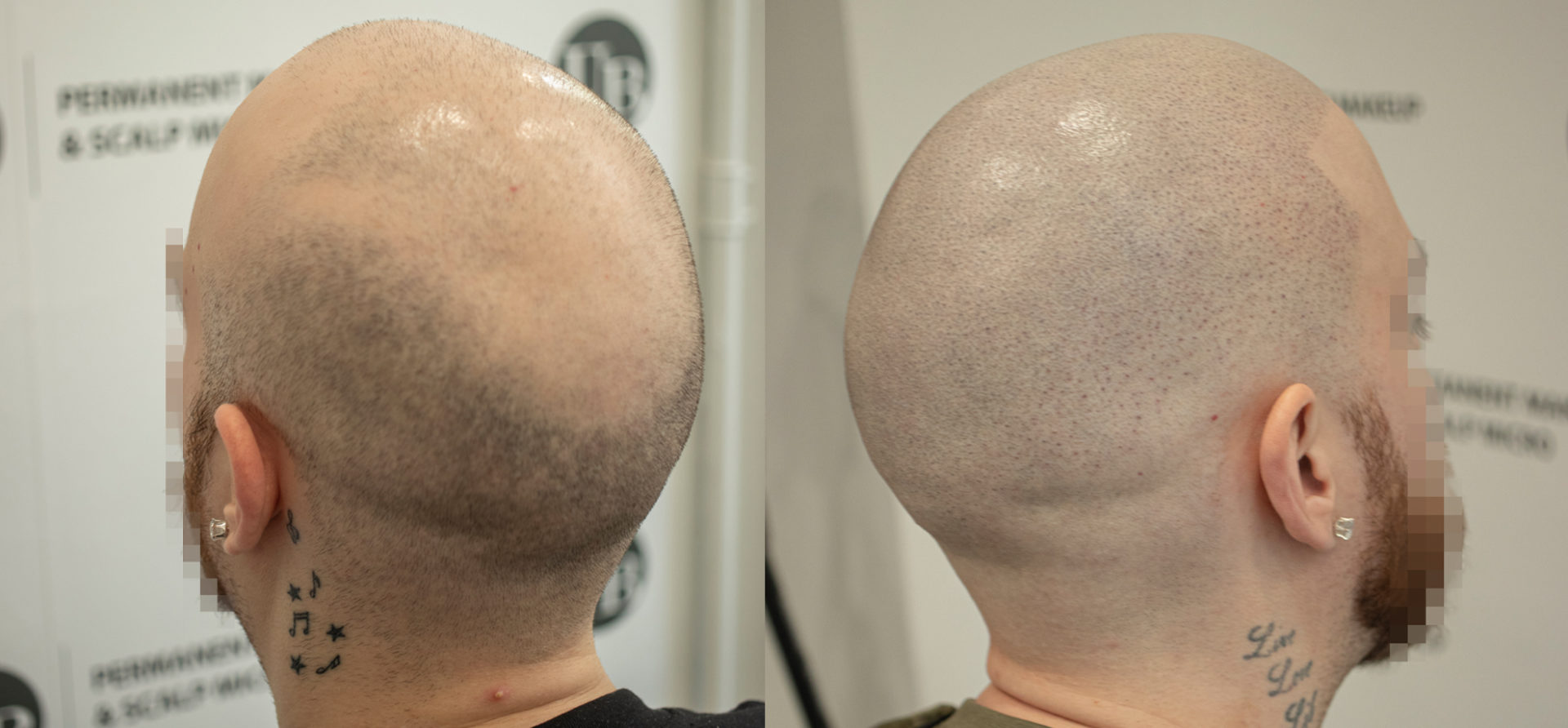Male-Pattern-Hair-loss-Toronto
