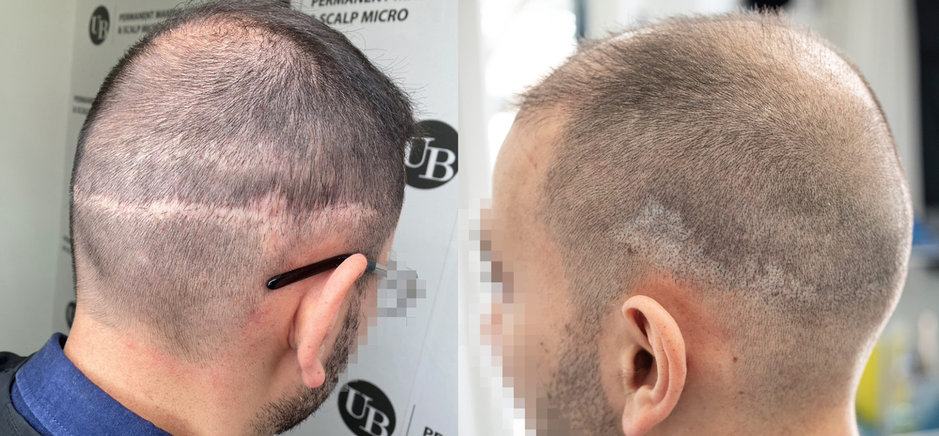 Micropigmentation-Hair-Tattoo-for-Hair-Transplant