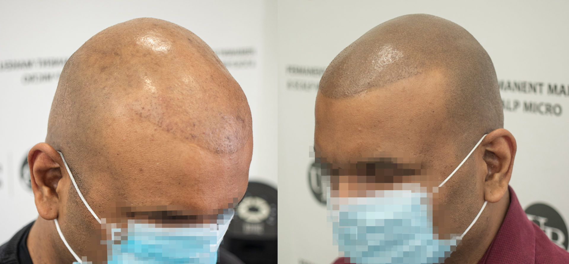 Repaired-Hair-Transplant-SMP-Hair-Tattoo