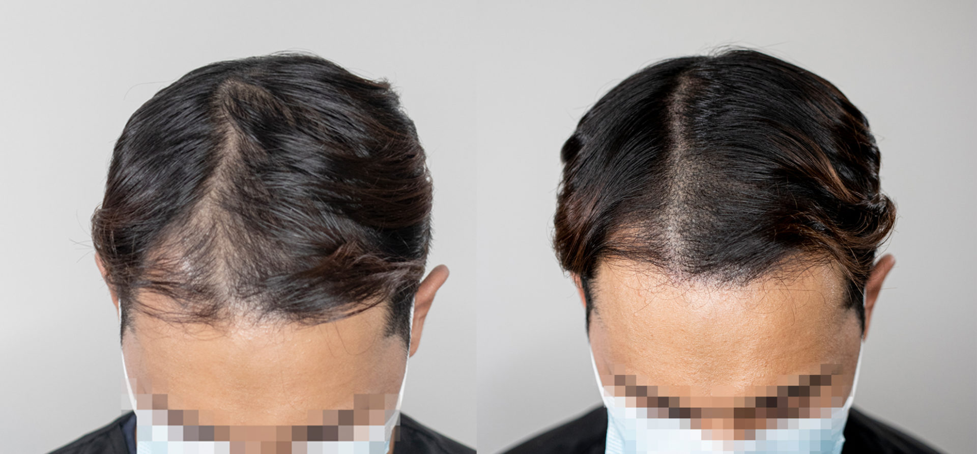 Scalp-Micropigmentation-Hair-Density-Treatment-Unyozibeauty