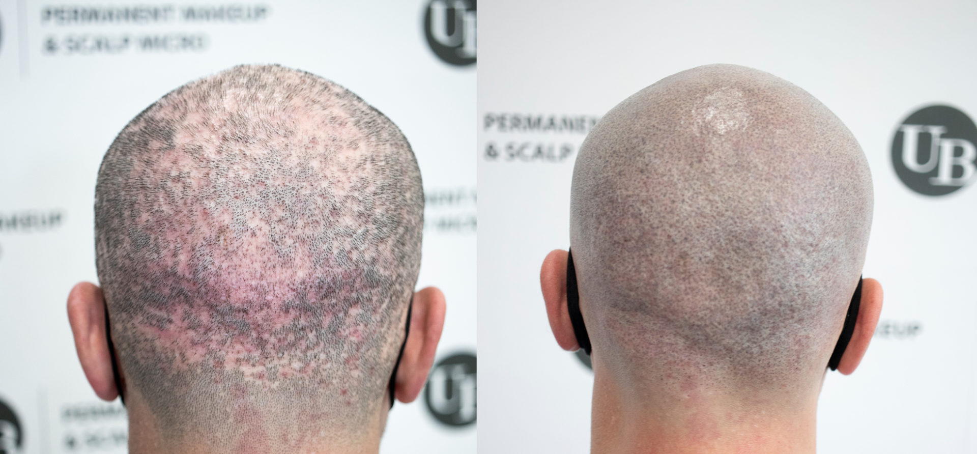 Scarring-Alopecia-Hair-Tattoo-Best-Hair-Loss-solution