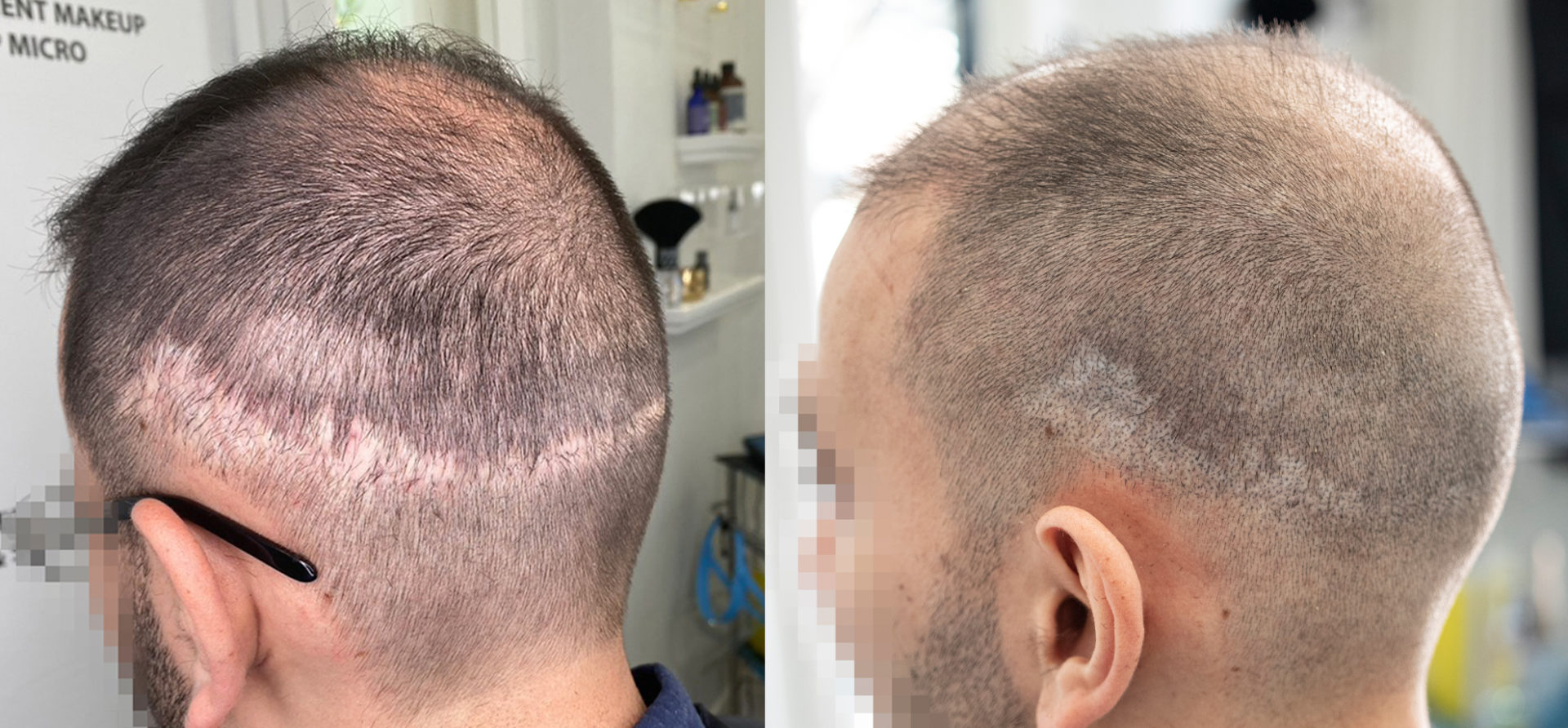Scars-from-Hair-Transplant-Scalp-Pigmentation-Solutions-Unyozibeauty