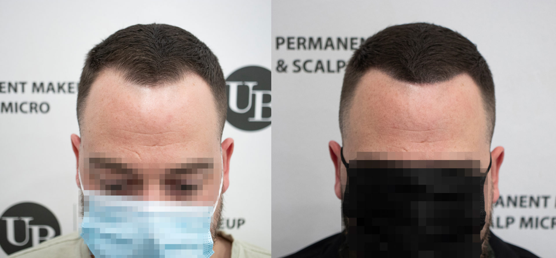 Thicker-Hair-with-Scalp-Micropigmentation