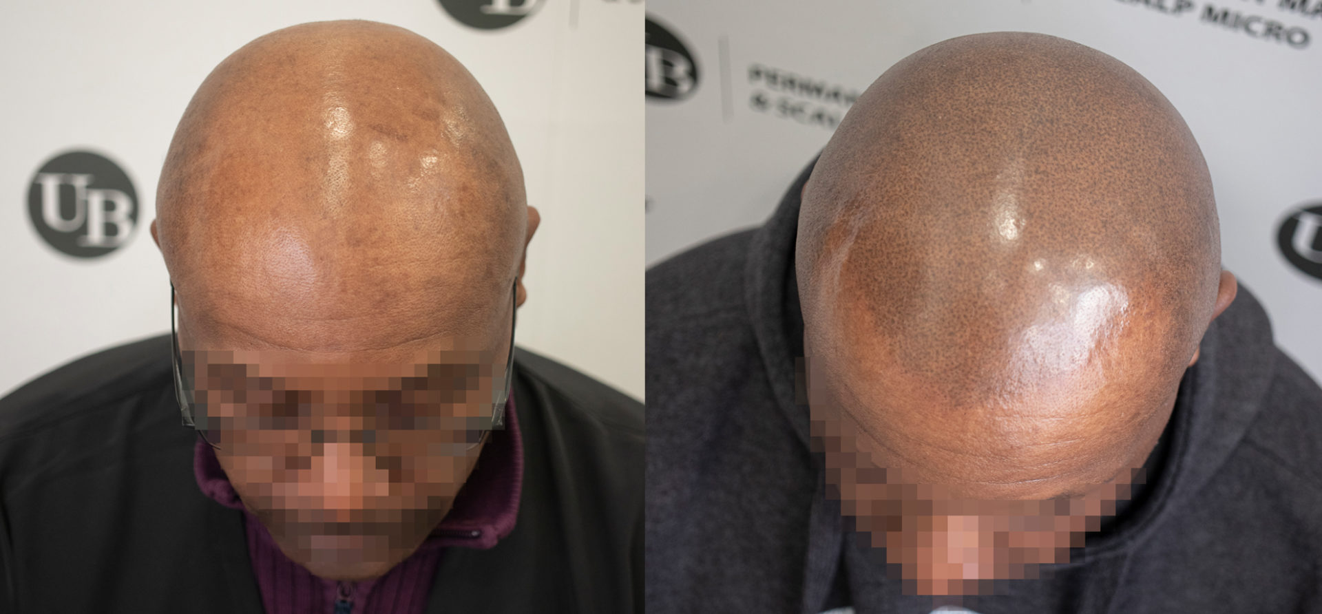 best-scalp-micropigmentation