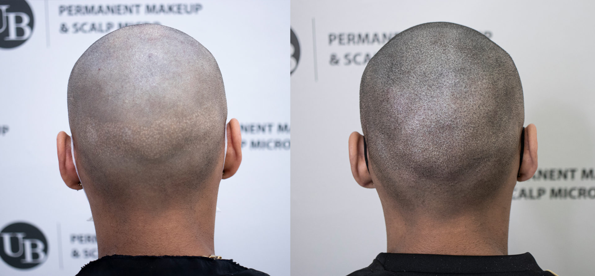 camouflaging-scars-from-hair-transplant-unyozibeauty