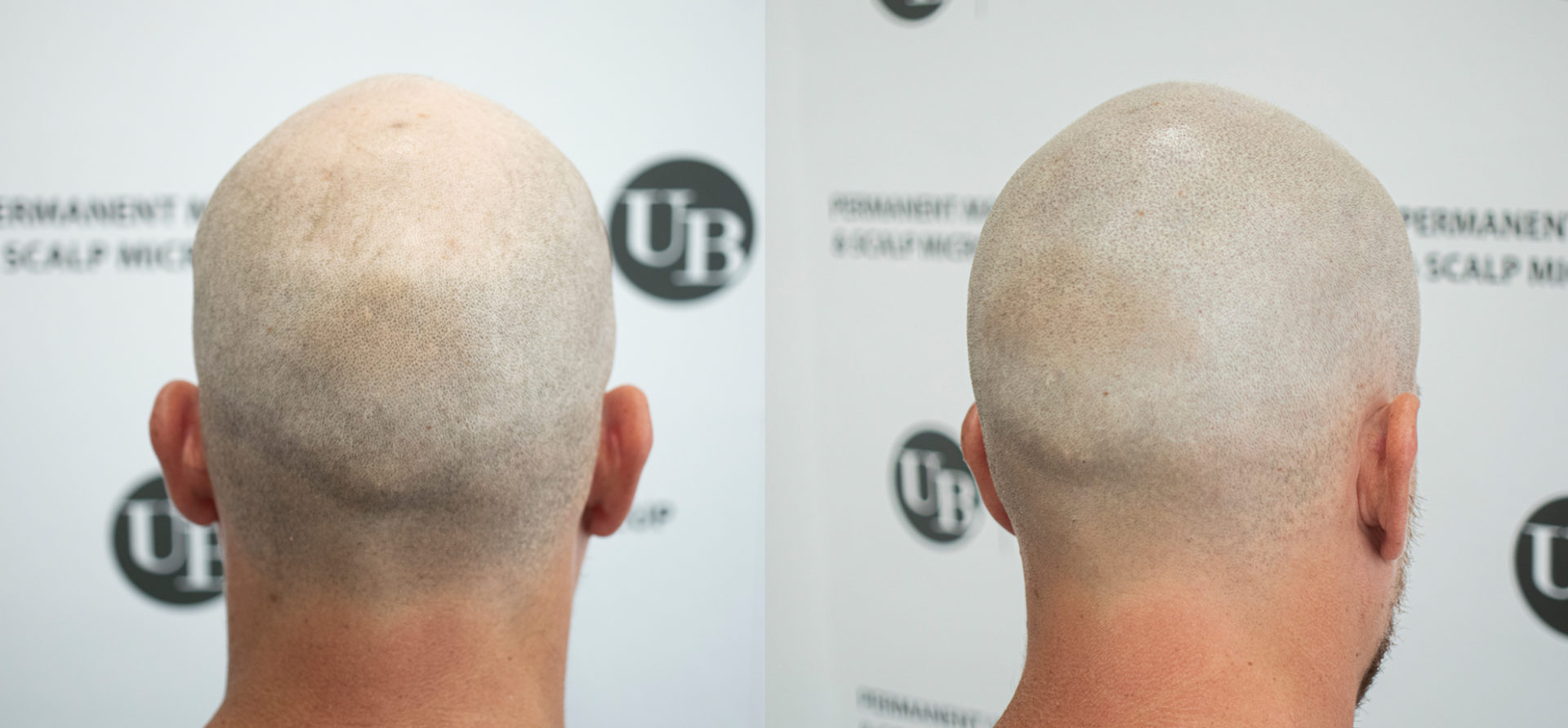 hair-loss-treatment-scalp-micropigmentation