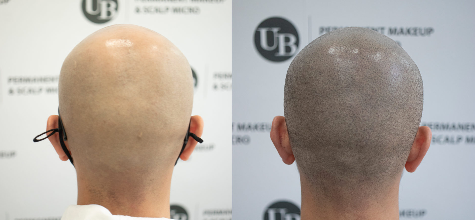 life-changing-procedure-scalp-micropigmentation-toronto