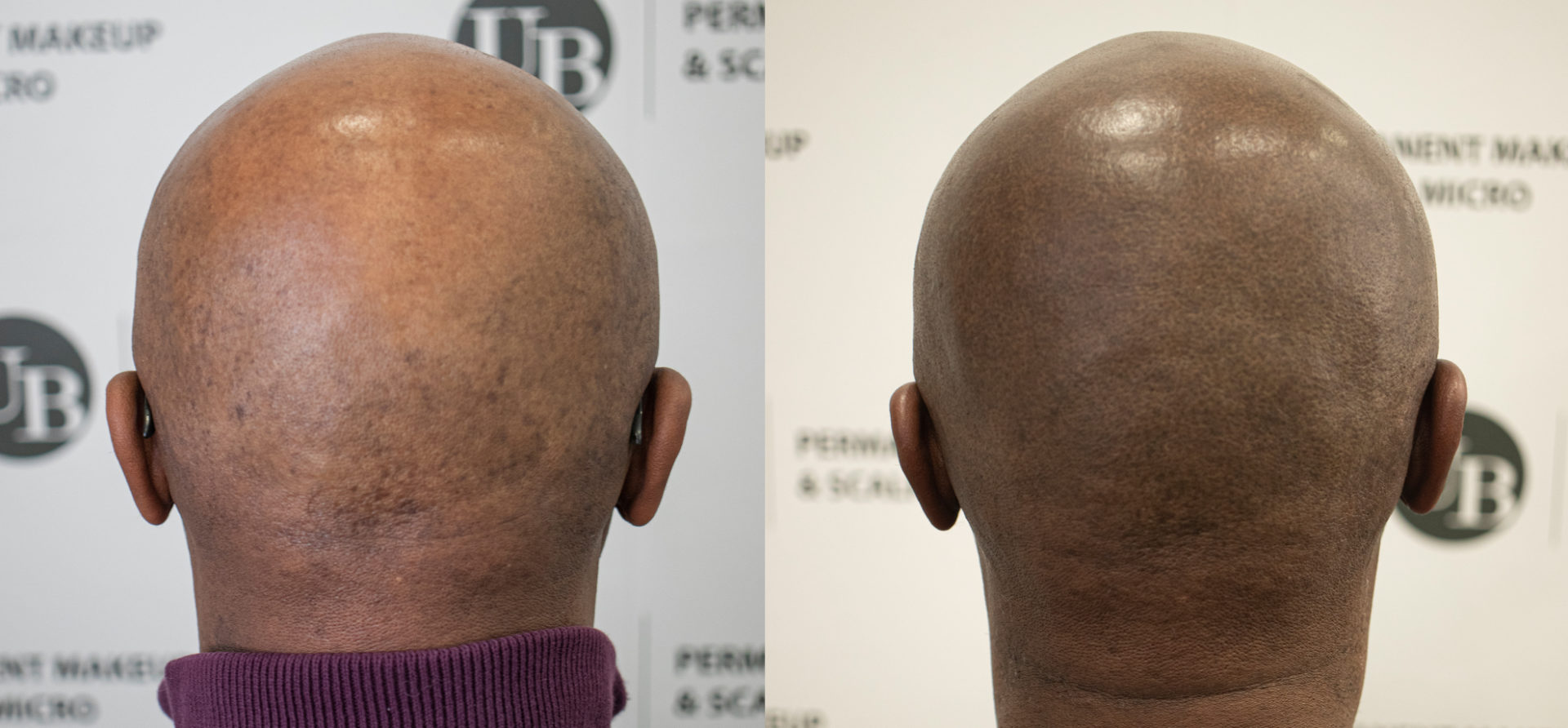 scalp-micropigmentation-for-black-men-toronto