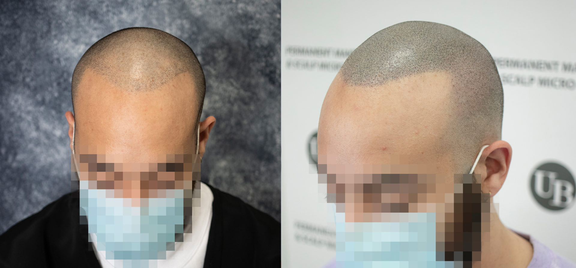 scalp-micropigmentation-non-surgical-solutions-to-hair-loss