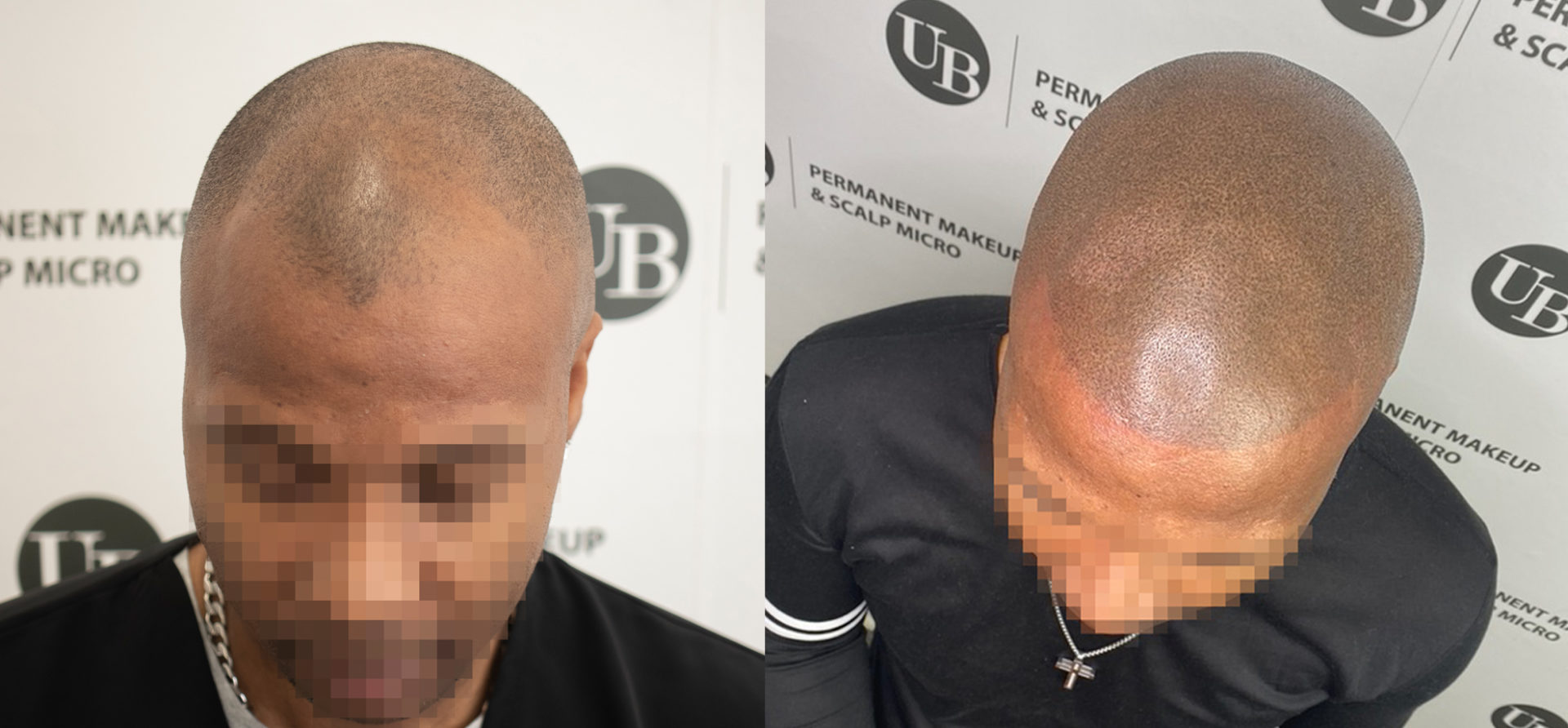 scalp-pigmentation-toronto-unyozibeauty