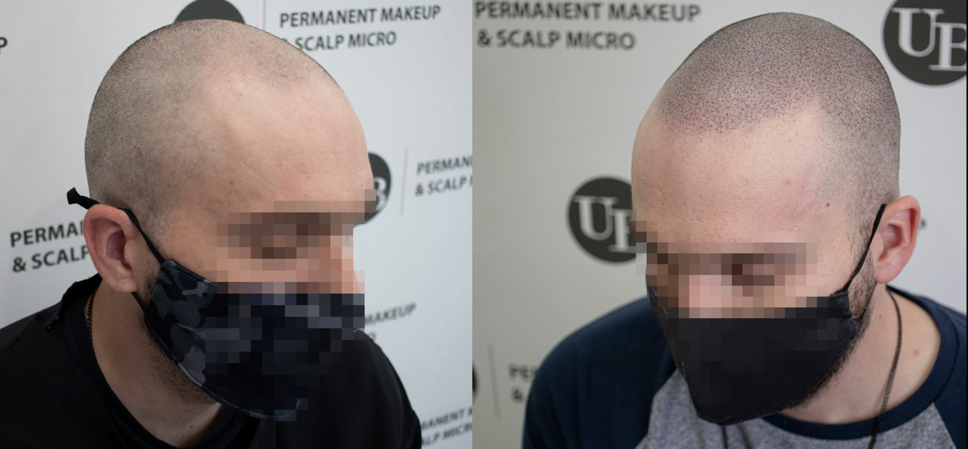 Broken-Hairline-Scalp-pigmentation-Toronto