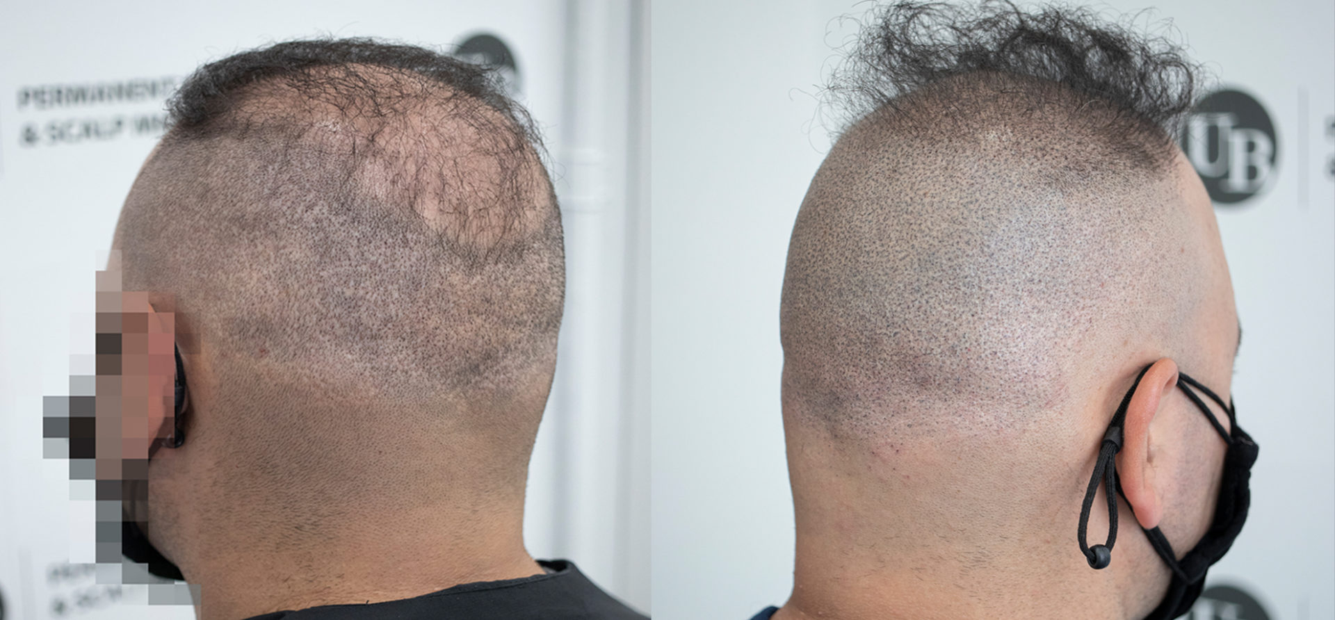 Hair-Loss-Restoration-SMP-Toronto