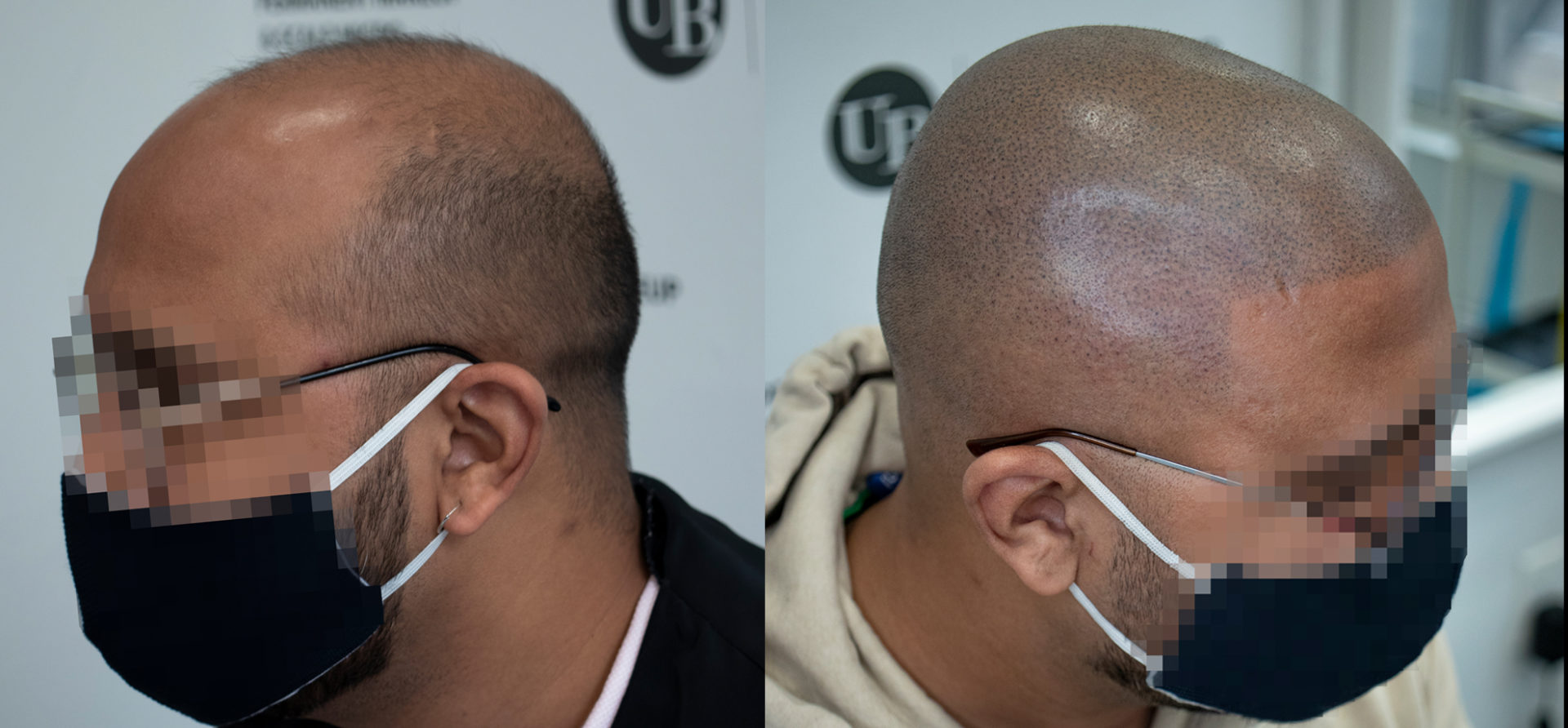 Hairline-Restoration-Scalp-Micropigmentation-Toronto