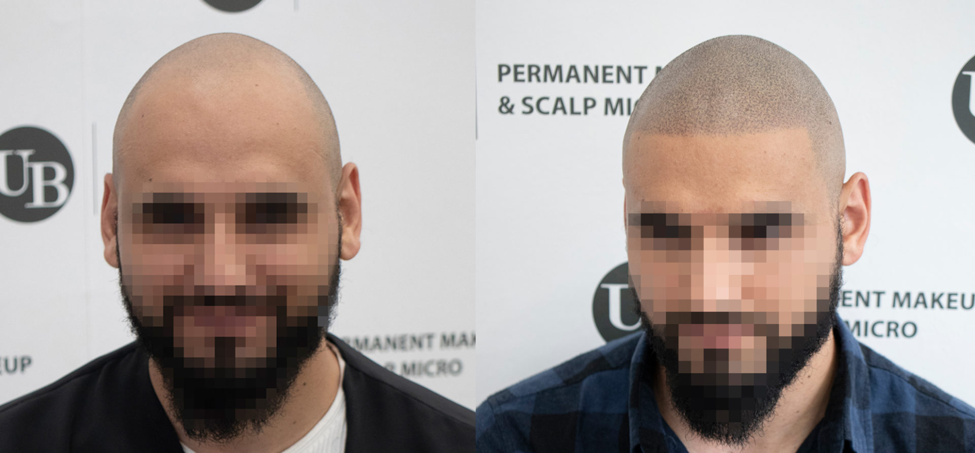 Natural-Looking-Hairline-Scalp-Micropigmentation