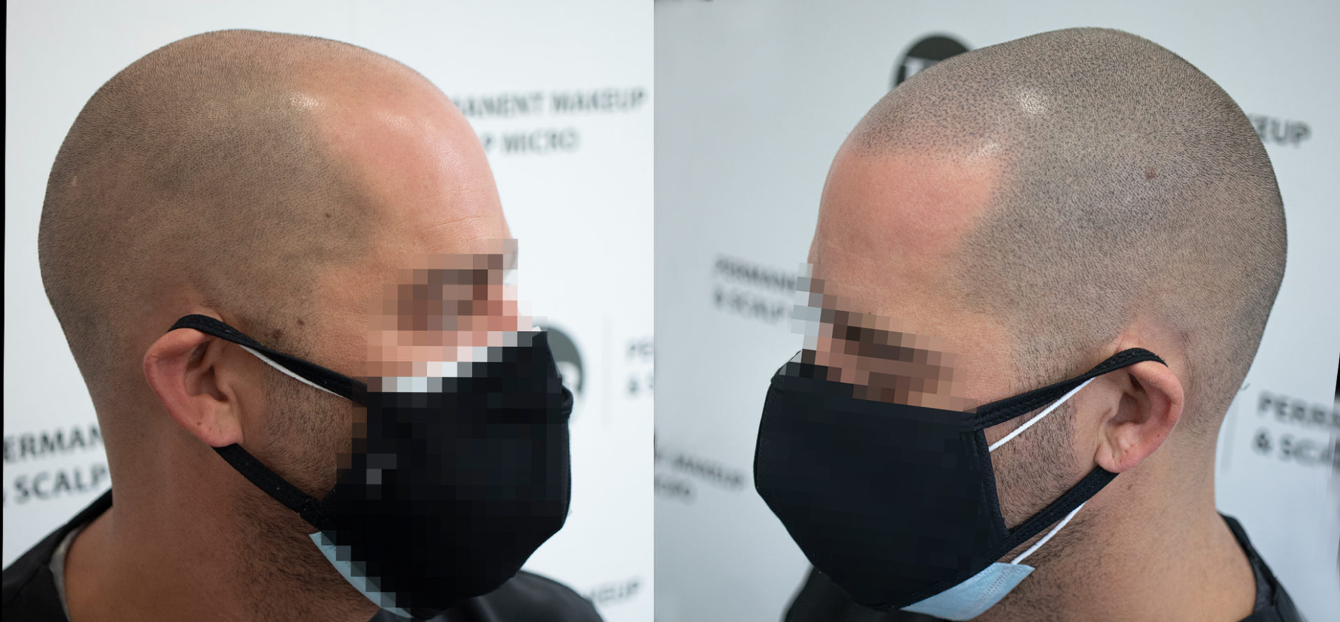 The-Buzzcut-Haircut-Scalp-Micropigmentation-Unyozibeauty
