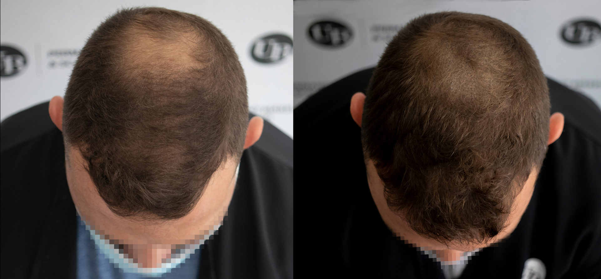 Thicker-hair-with-Scalp-Micropigmentation