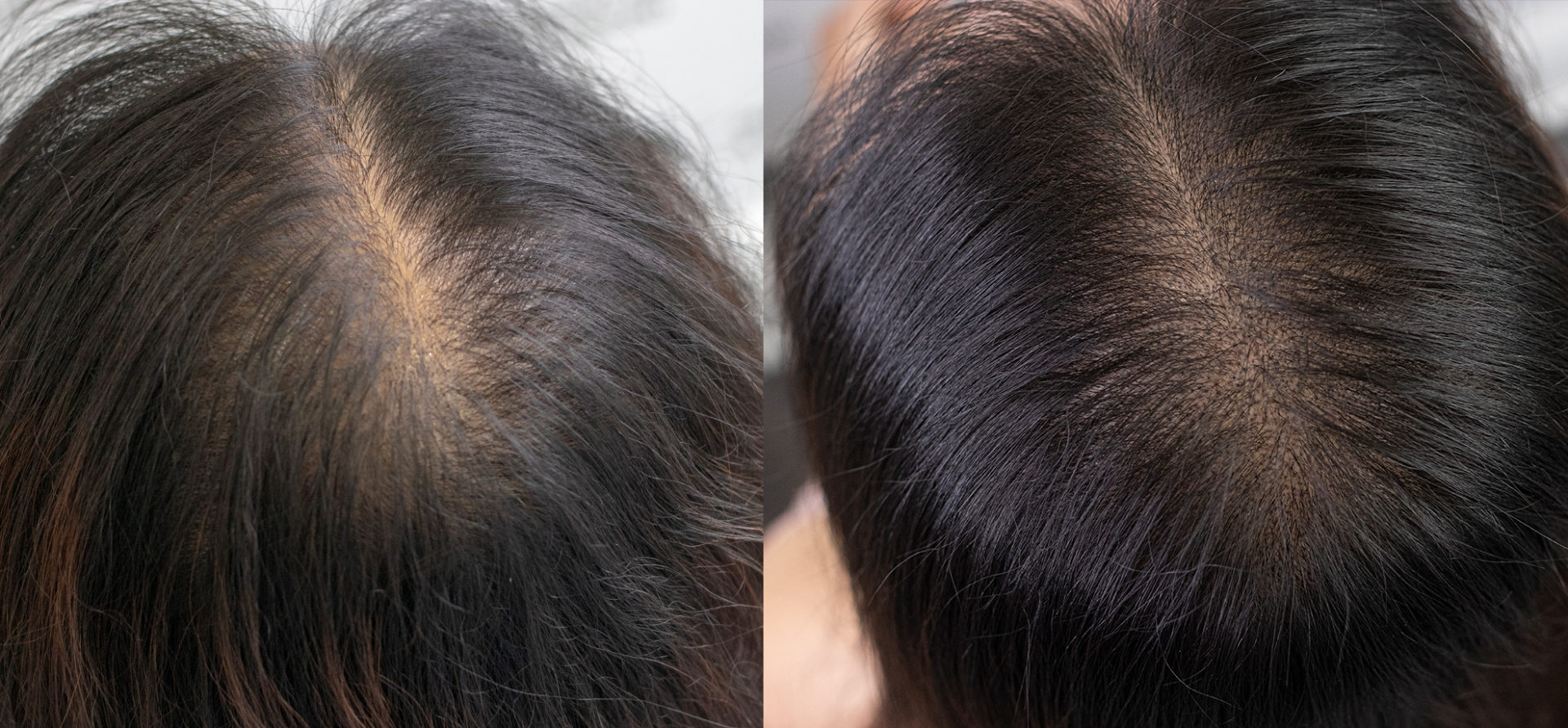 best-female-scalp-micropigmentation-toronto