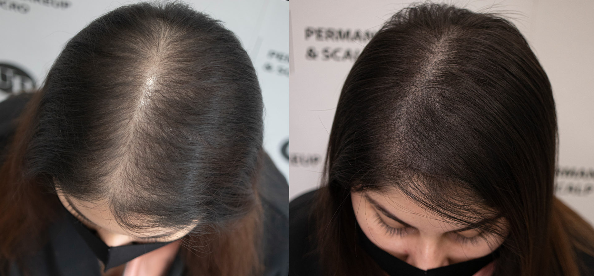 female-hair-density-toronto
