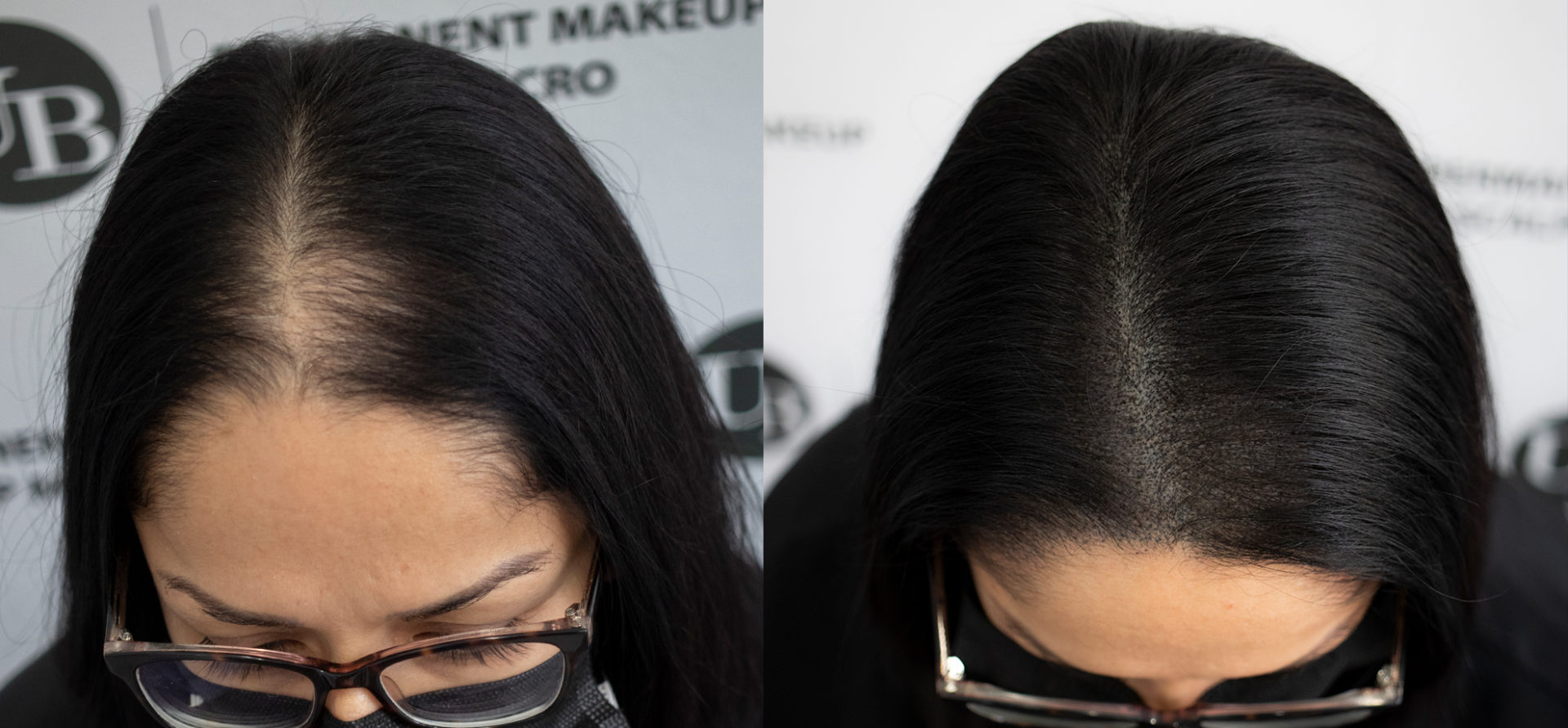 female-hair-loss-solutions-toronto-unyozibeauty