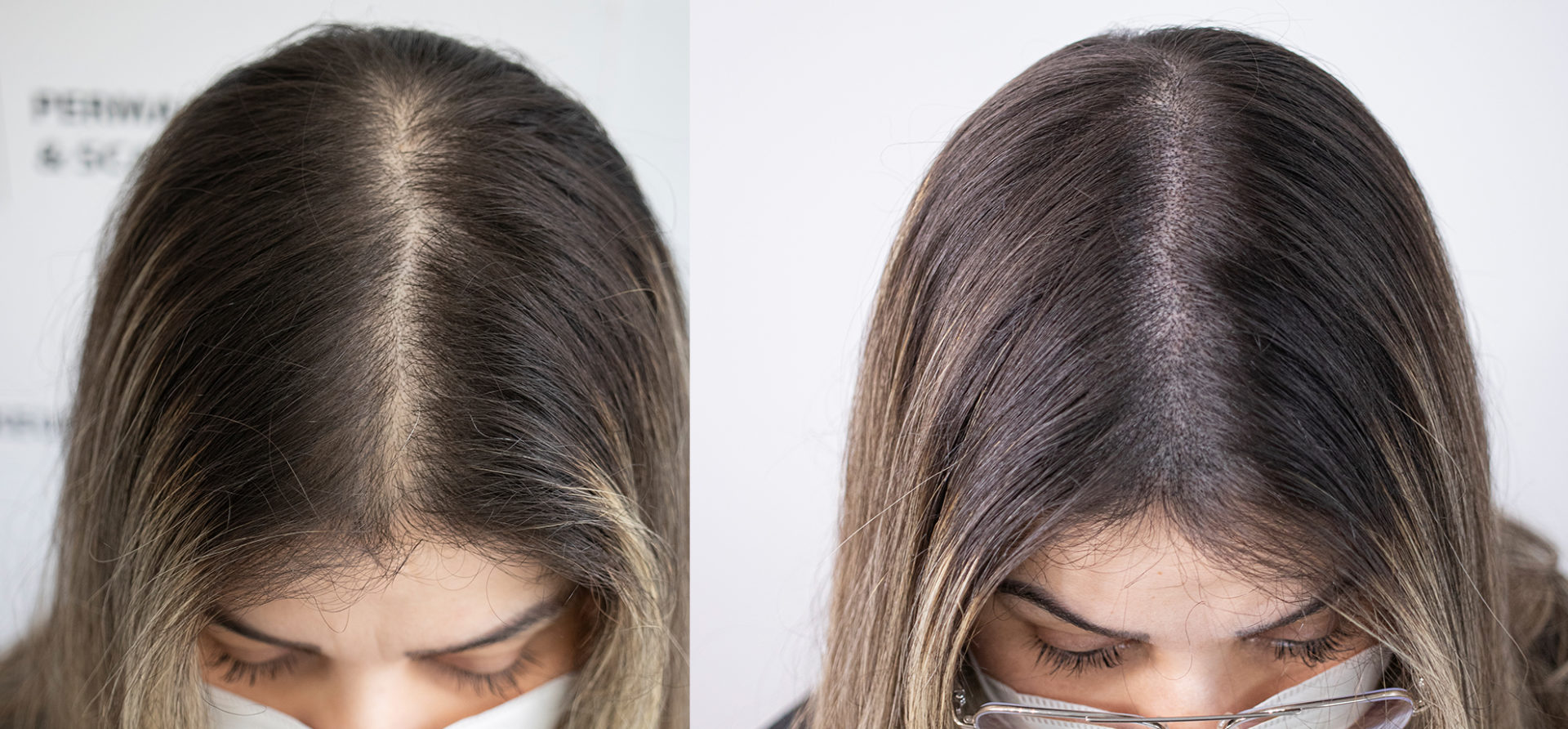 female-scalp-micropigmentation-unyozibeauty