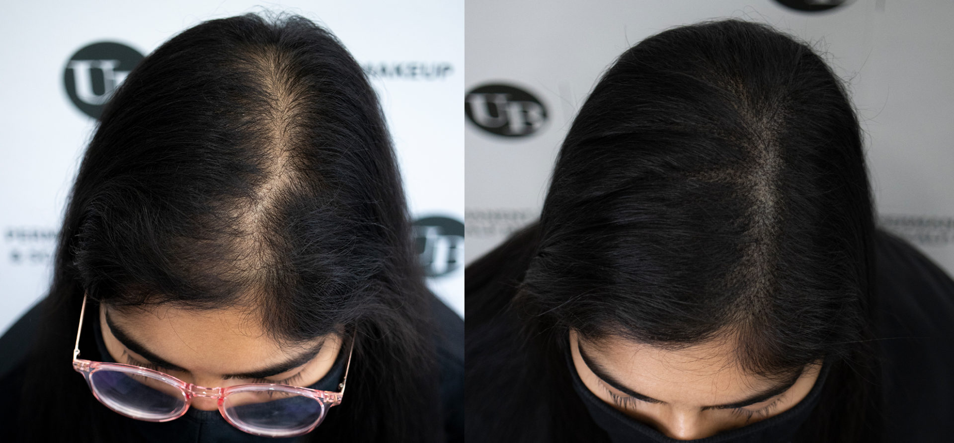 natural-hair-density-transformation-toronto-unyozibeauty