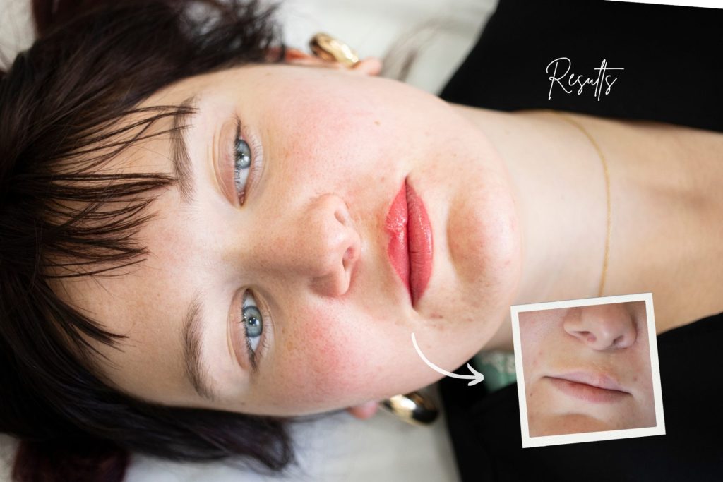 CLEFT LIP PIGMENTATION TREATMENT UNYOZI BEAUTY TORONTO