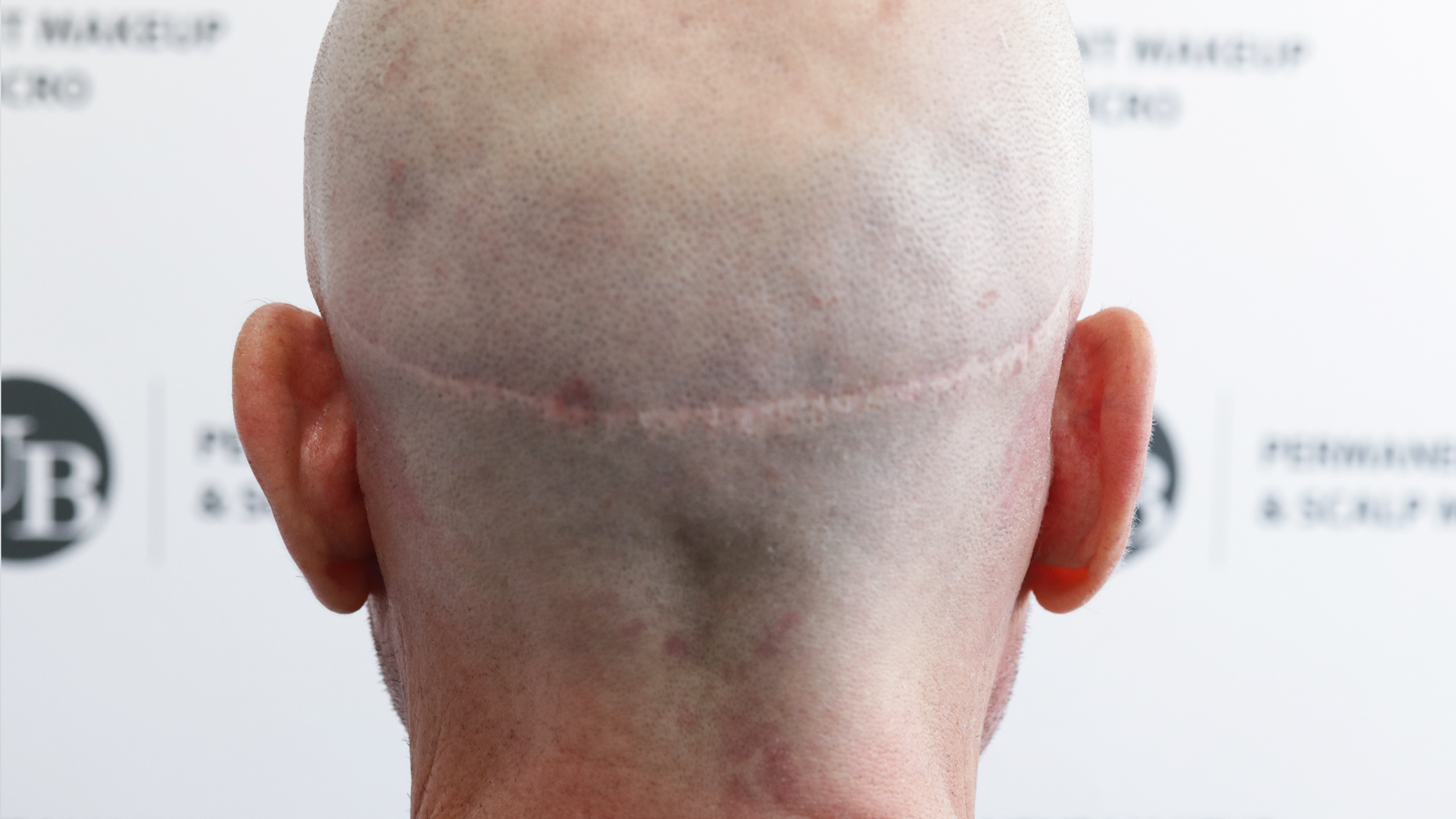 hair transplant scar