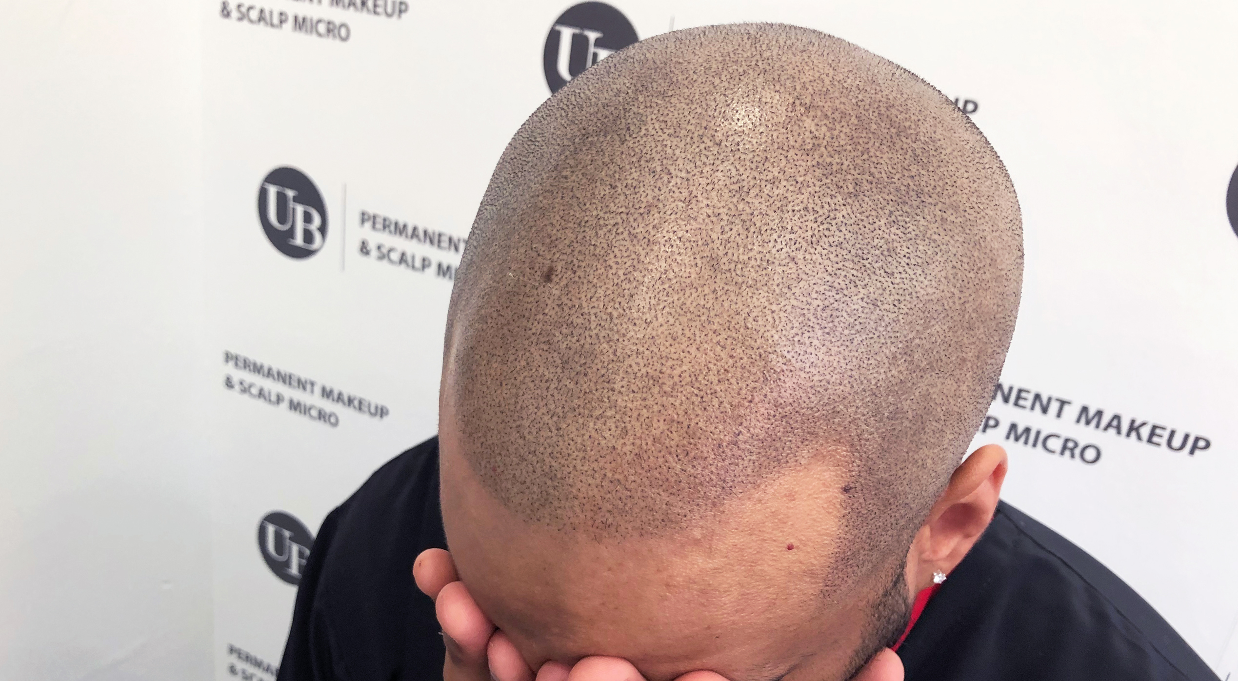 Hair Tattoo the best solution to hair loss by Shirley Marin - Unyozi Beauty  - Permanent Makeup & Scalp Micropigmentation