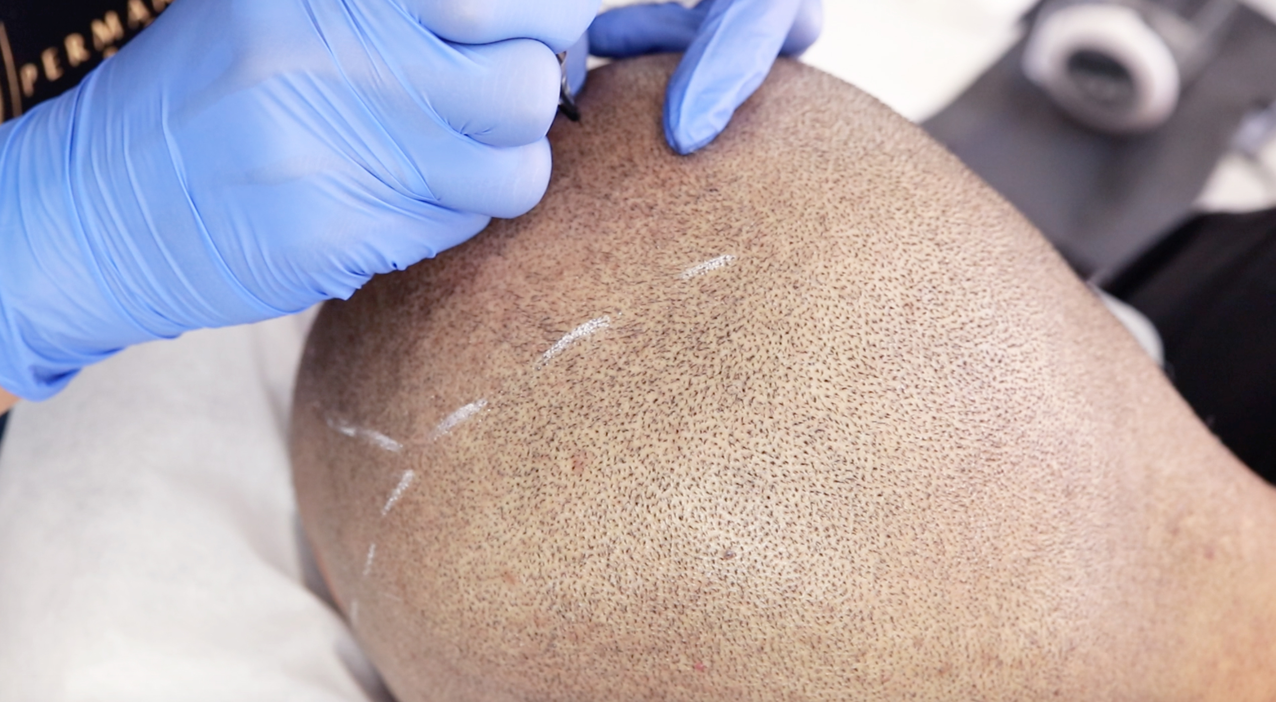 How Scalp Micropigmentation Can Give You Fuller Hair | Seattle Met