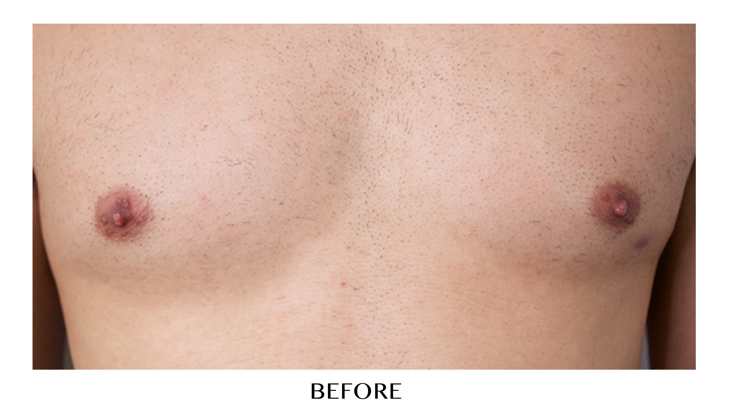 Areola Pigmentation for Men - Medical Tattoo - Unyozi Beauty - Permanent  Makeup & Scalp Micropigmentation