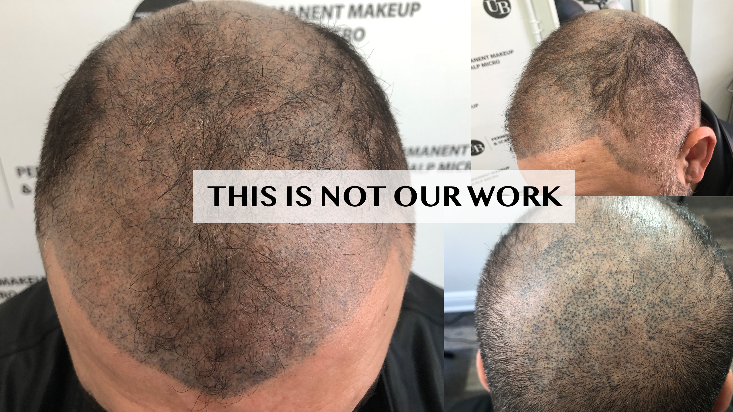 Scalp Micropigmentation For thininng hair - Scalp Art Clinic